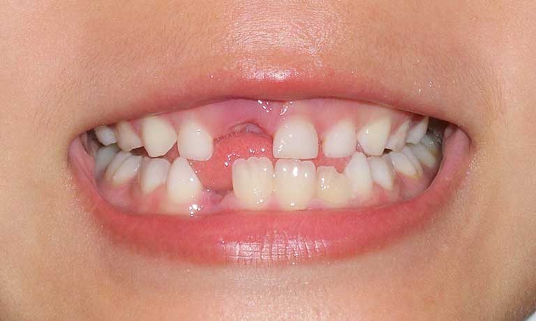 乳歯の抜歯の様子